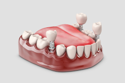 regime-alimentaire-apres-une-pose-d-implants-dentiste-paris-19